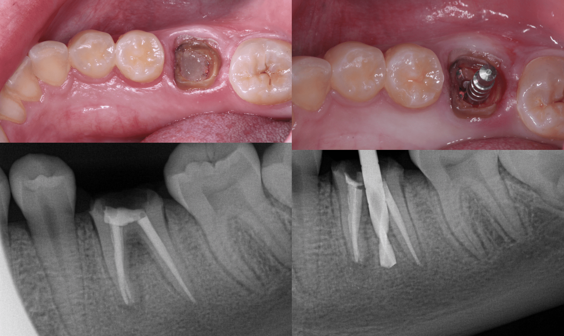 Punk Your Endodontist: Immediate Molar Implant through a ...