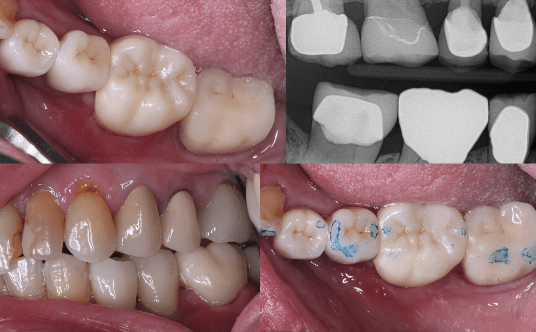 Race to the Bottom? A $3.85 Zirconia crown from a CEREC scan - Digital