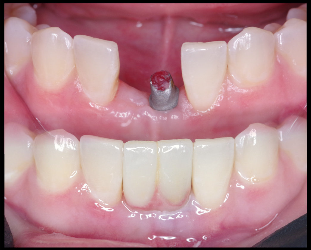 Implant Cantilever with ZirCAD Multi Digital Enamel