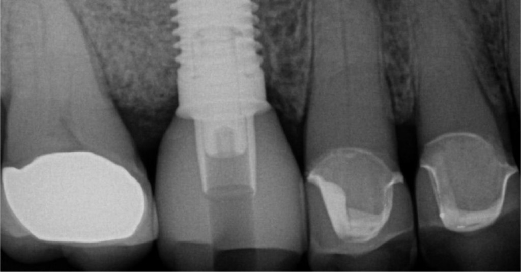 cerec tessera vs emax cerec tessera vs emax