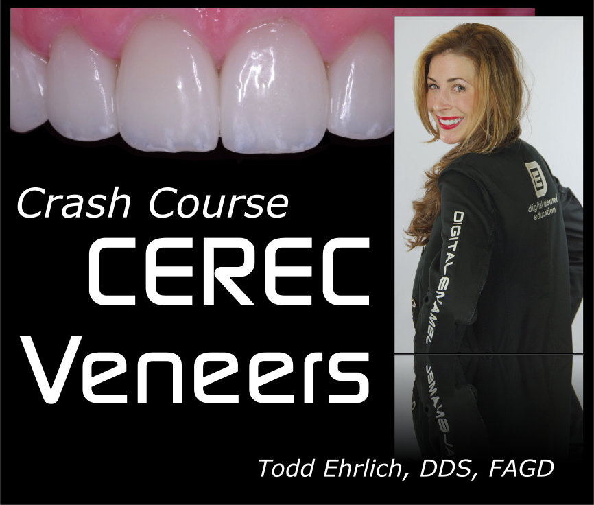 CEREC Veneer Crash Course Side Panel