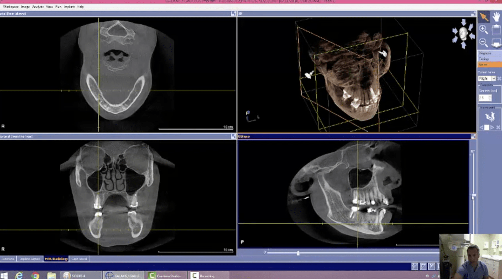 Introduction to CEREC Guide 2 with Implant Direct Implants: Nerve