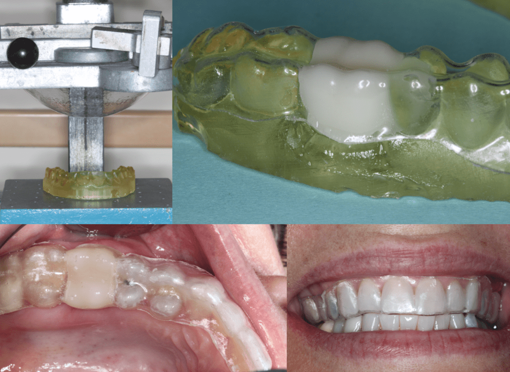CEREC Meets Flipper 3D Printed Essix with CEREC Scan and 7mm Legacy