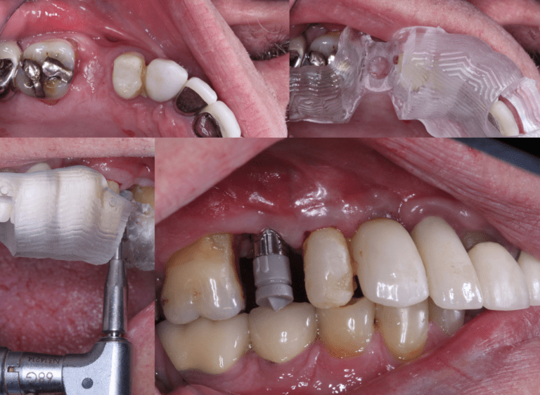 Lumpy Part 2: Enamic Healing Abutment/Speedfire Zirconia/Replant ...