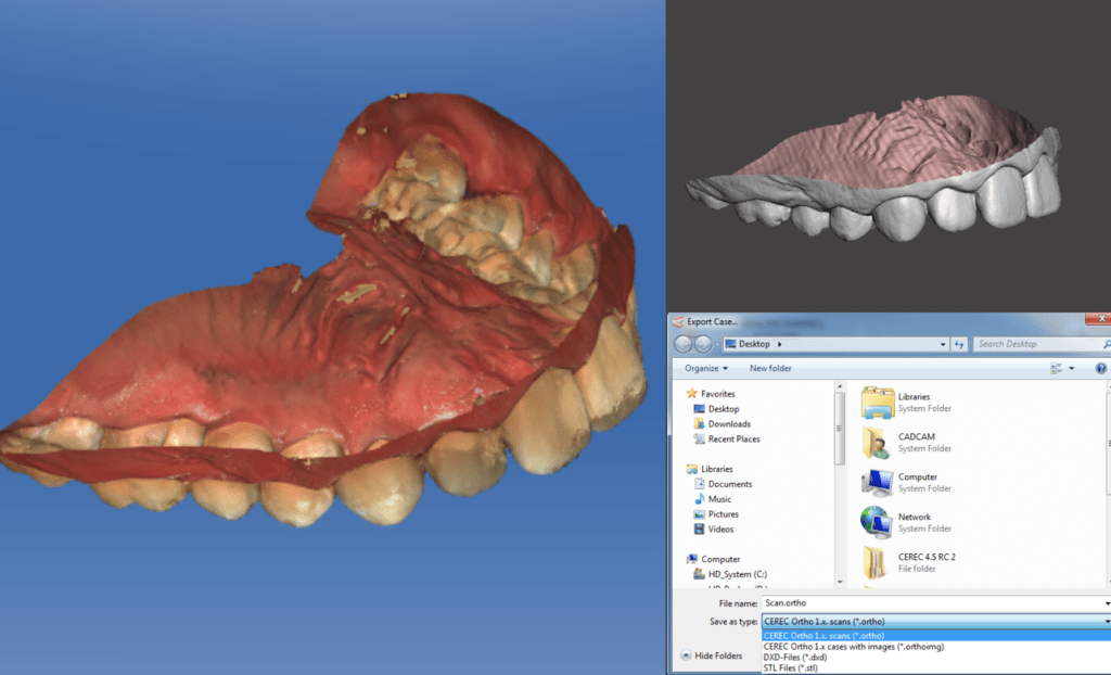 export stl cerec bluecam