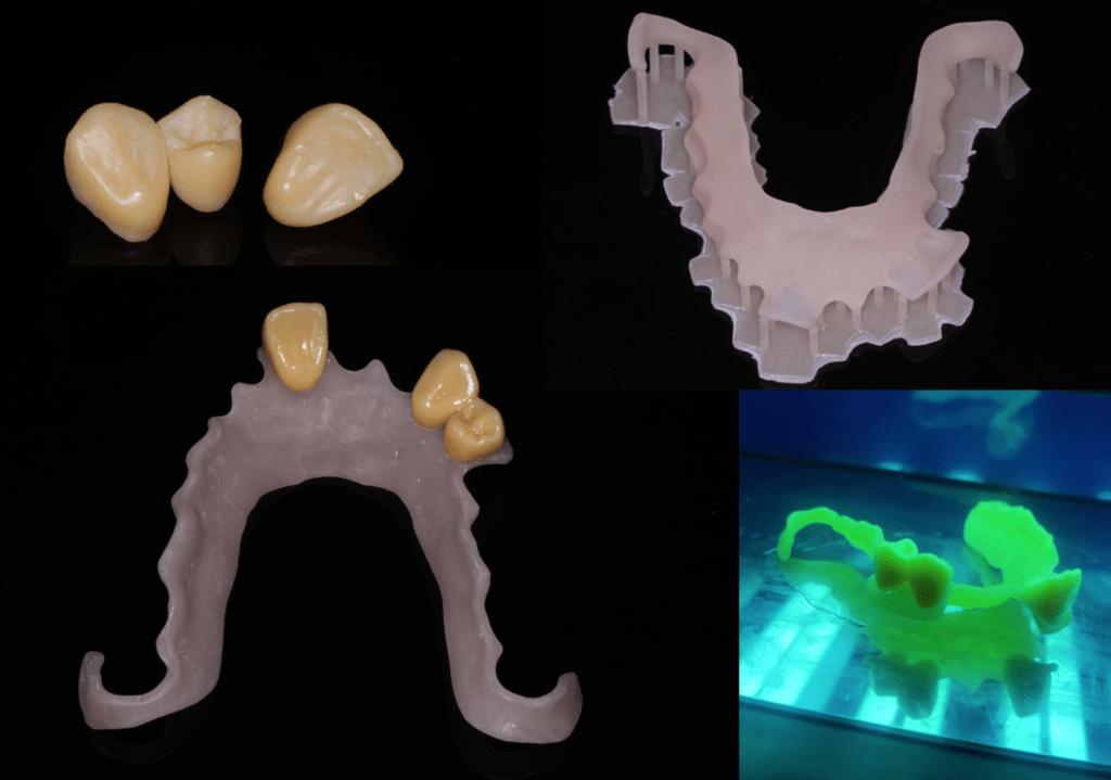 "Flipping" Out with CEREC and ExoCAD 3D Printed Flippers Digital Enamel