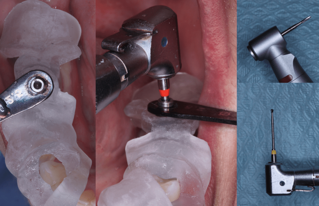 Best time for a CEREC Endo Guide? 230!! Root canal with printed CEREC