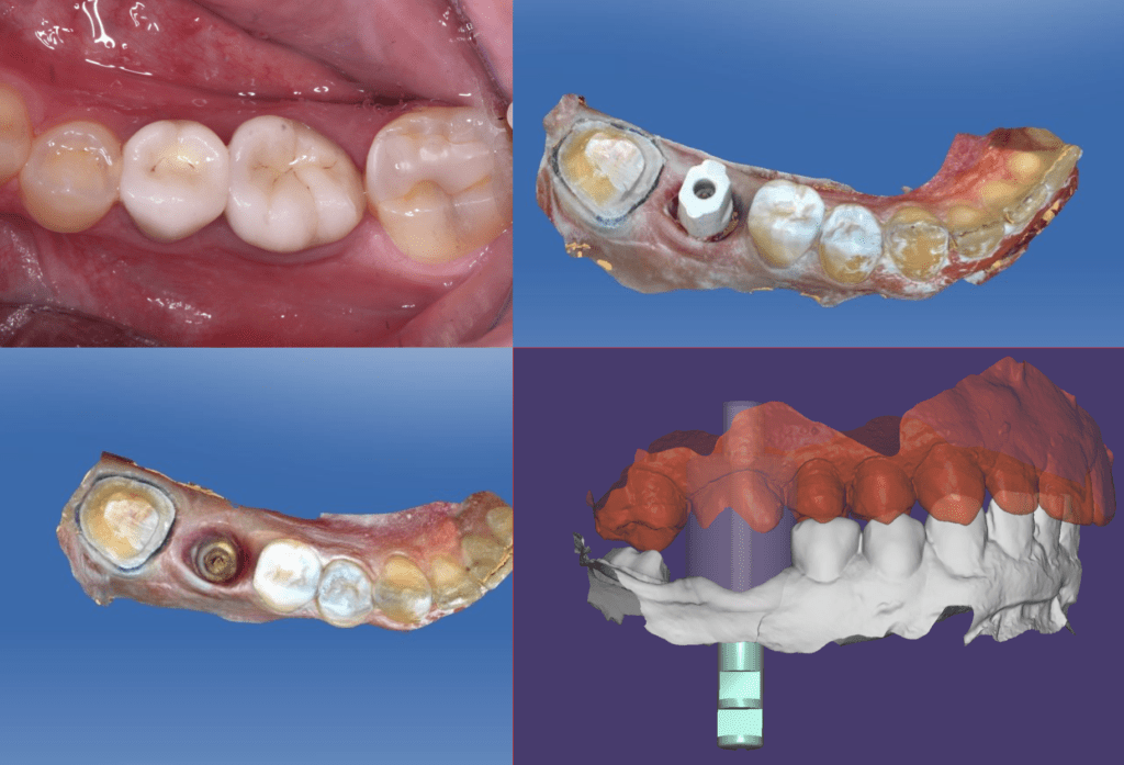 I Want to Believe An Alien 45 Implant Crown and a 22 single Zirconia