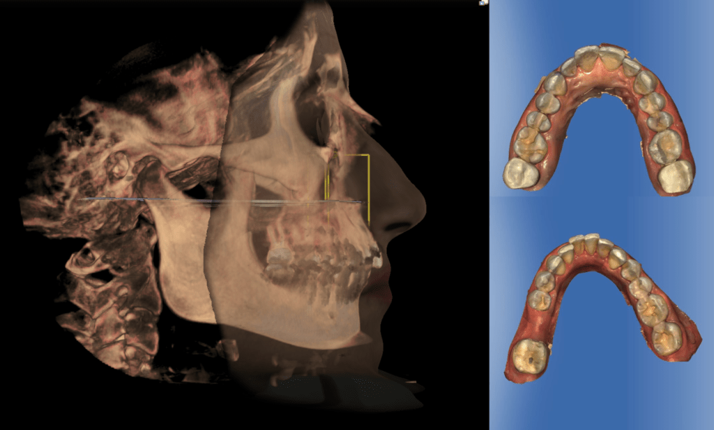 I Like to Move It Move It: In office 3D Printed aligners with Archform ...