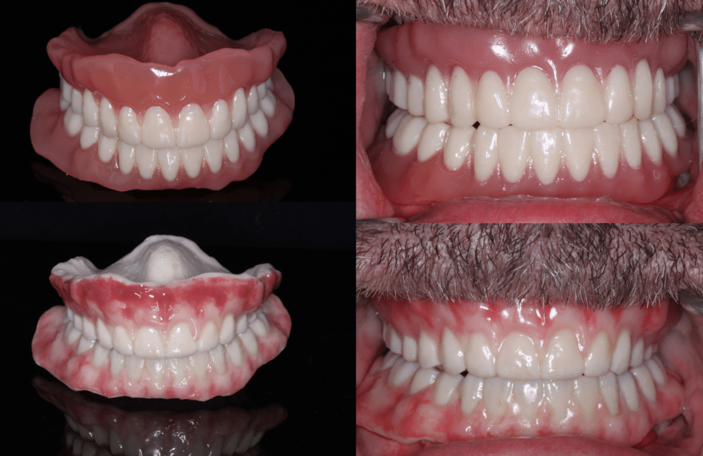 Print a Pair 3D Printed Dentures with Moonray Digital Enamel