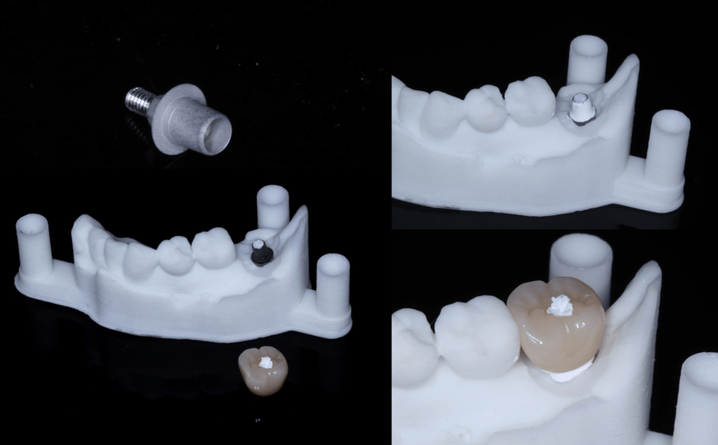 Zirconia Implant Crowns are Evolving TZi Stain and Glazed Implant Crown by Evolve Dentistry on