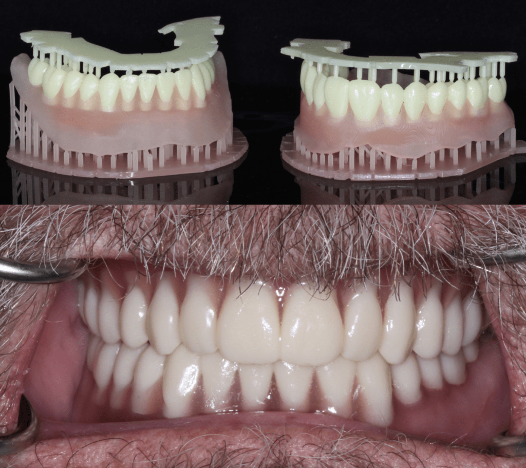 Print Like a Pro: New Sprintray Pro Guided URIS Implant by Tru Abutment ...