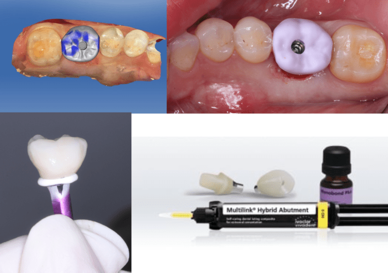 Get Low Simple Sub Crestal Legacy 4 Implant With Emax Screw Retained