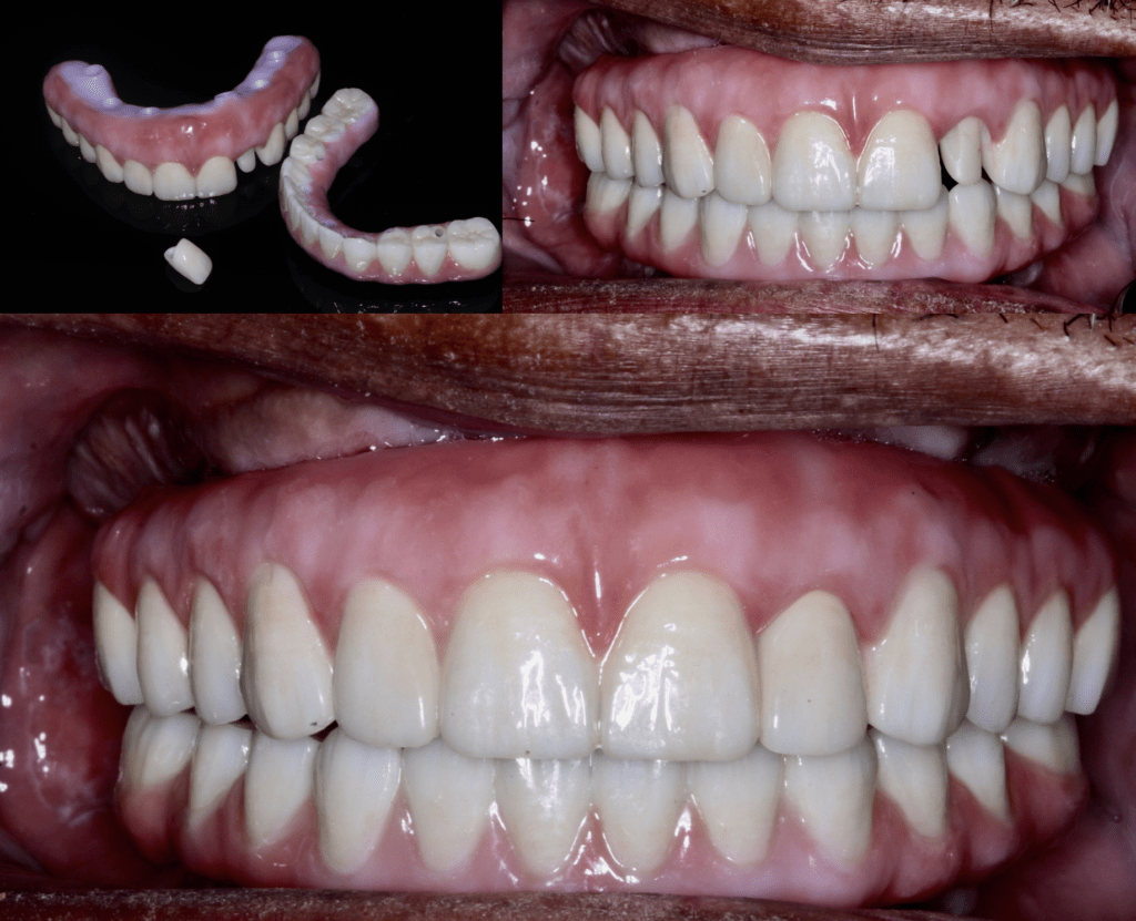 Good With The Gums: Fully Digital Hybrids printed on Carbon Layering by ...