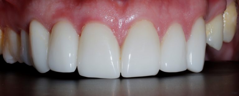 Solving a Maxillary Cant Chairside - Digital Enamel