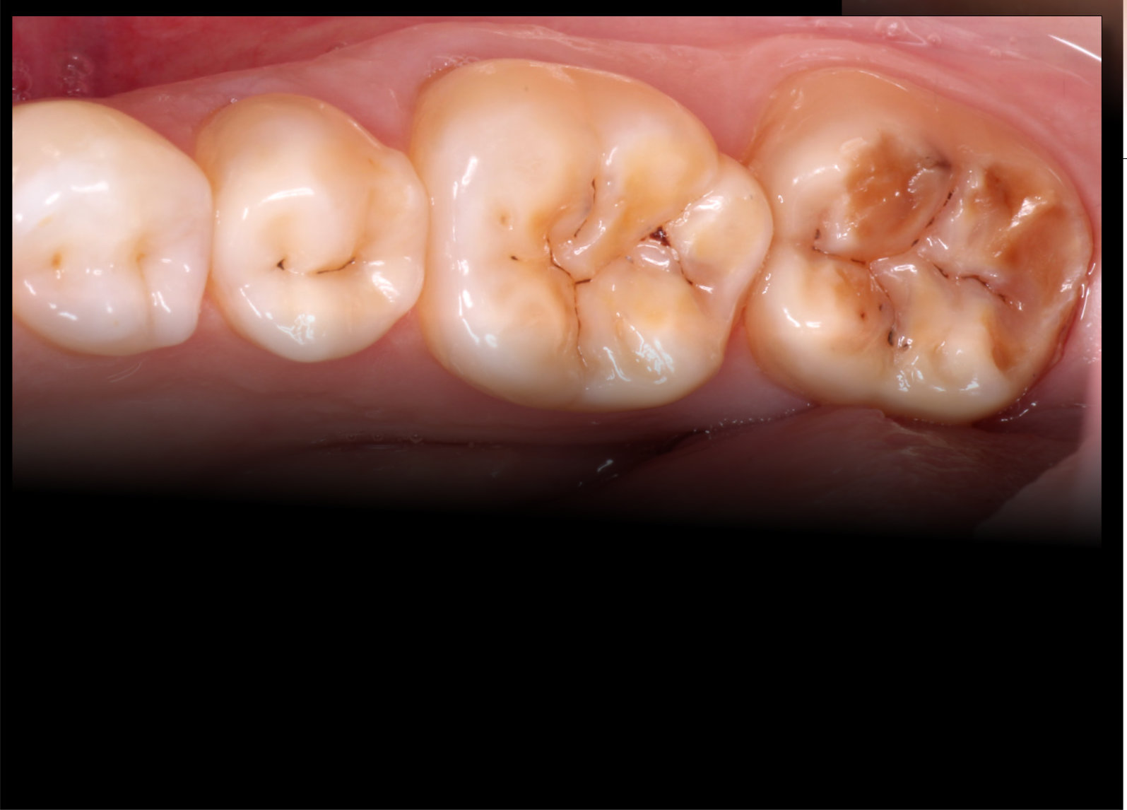 Amelogenesis Imperfecta Progression And Digital Solution Digital Enamel