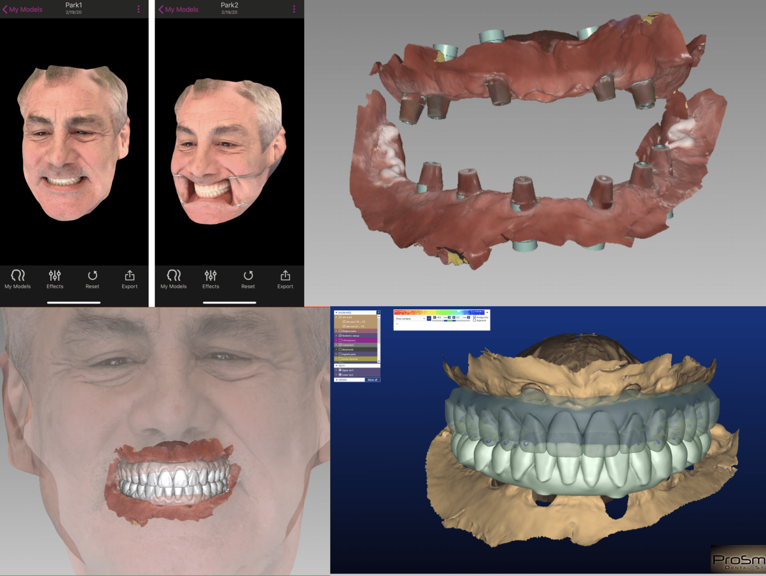 So "Over" Overdentures Converting an OVD to Hybrid with CEREC Primescan and Imetric at Implant