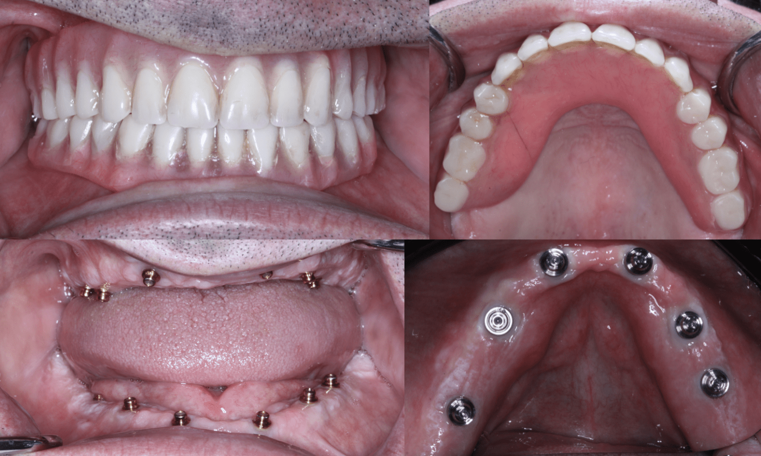 So "Over" Overdentures Converting an OVD to Hybrid with CEREC Primescan and Imetric at Implant