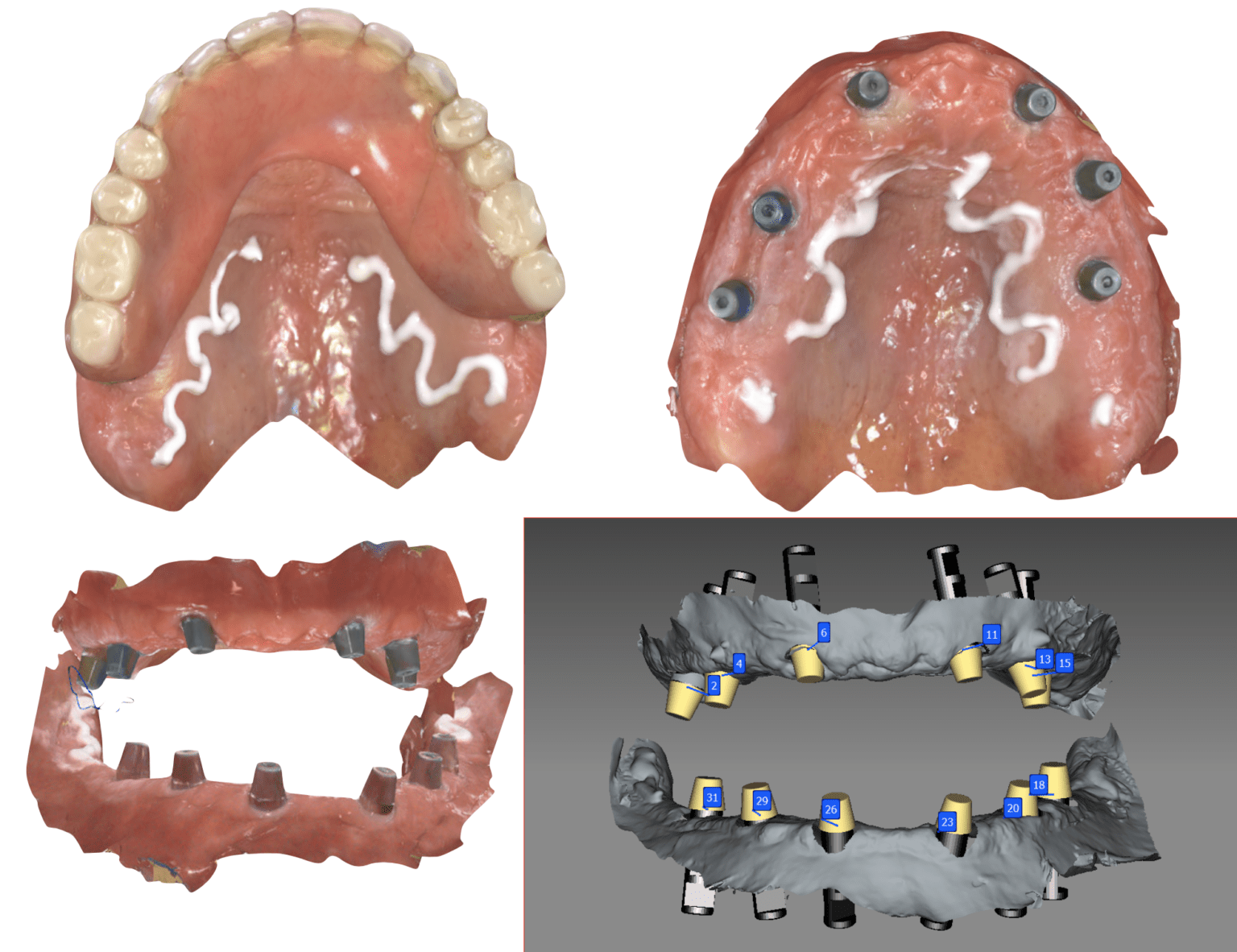 So "Over" Overdentures Converting an OVD to Hybrid with CEREC Primescan and Imetric at Implant